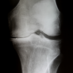 Knee xray, x-ray, arthritis, osteoarthritis