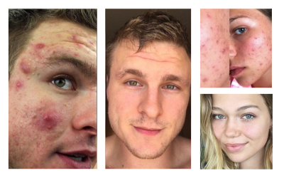 Before and after acne pictures
