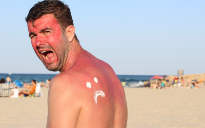 Sunburned man on beach